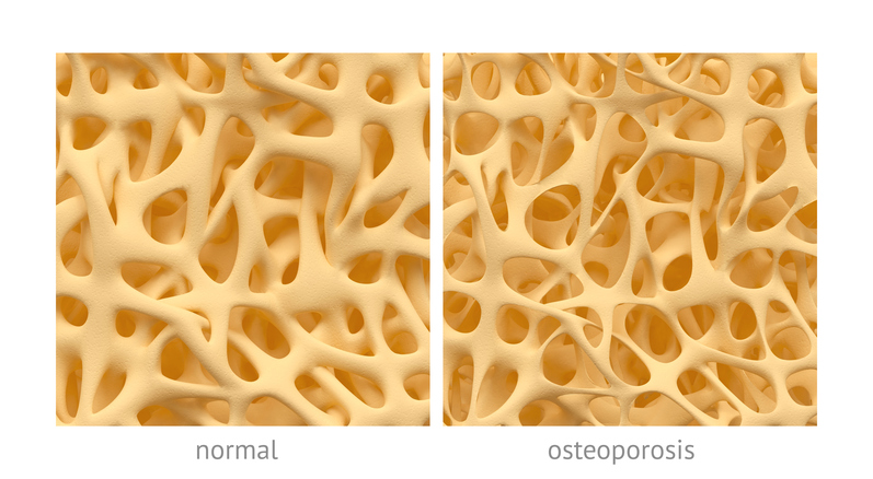 kost sa normalnom strukturom i sa strukturom kod osteoporoze